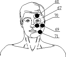 Рис.34 Поля воздействия при невралгии тройничного нерва слева по ходу нерва и точки выхода лицевого нерва
