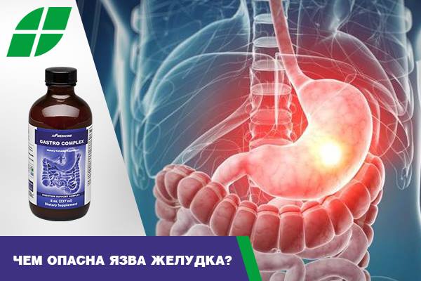Чем опасна язва желудка?