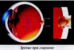 Зрение при глаукоме