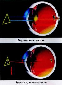 Нормальное зрение/Зрение при катаракте
