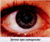 Зрение при катаракте