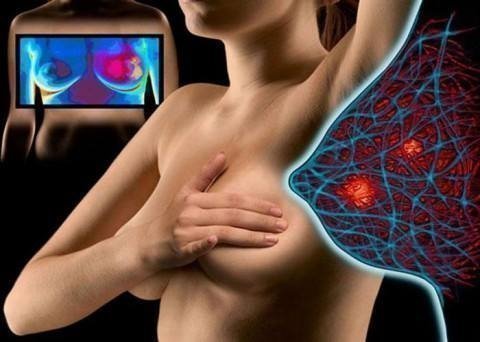 Женское здоровье: мастопатия - помогут литовиты!