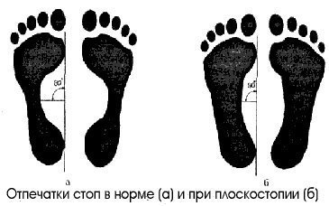 Отпечатки стоп в норме (а) и при плоскостопии (б)