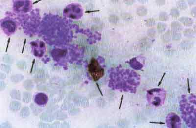 Сегмснтно-ядерныс лейкоциты с набухшими от токсинов ядрами, погибая, но атакуя трихомонад, заставили их гранулироватьcя до «тромбоцитов». Цистоподобная трихомонада (внизу слева). Kycoчек холестерина (в центре), попавший из печени в кровь.