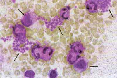 Амебовидные трихомонады, атакуемые палочкоядерными и сегментно-ядерными лейкоцитами, распались до «тромбоцитов». Лимфоцит (внизу справа) захватил и фагоцитирует «тромбоцит». (слева от него трихомонада в одной из стадий перехода к грануляции и распаду