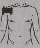 Поражения (артроз, артрит) плечевого сустава